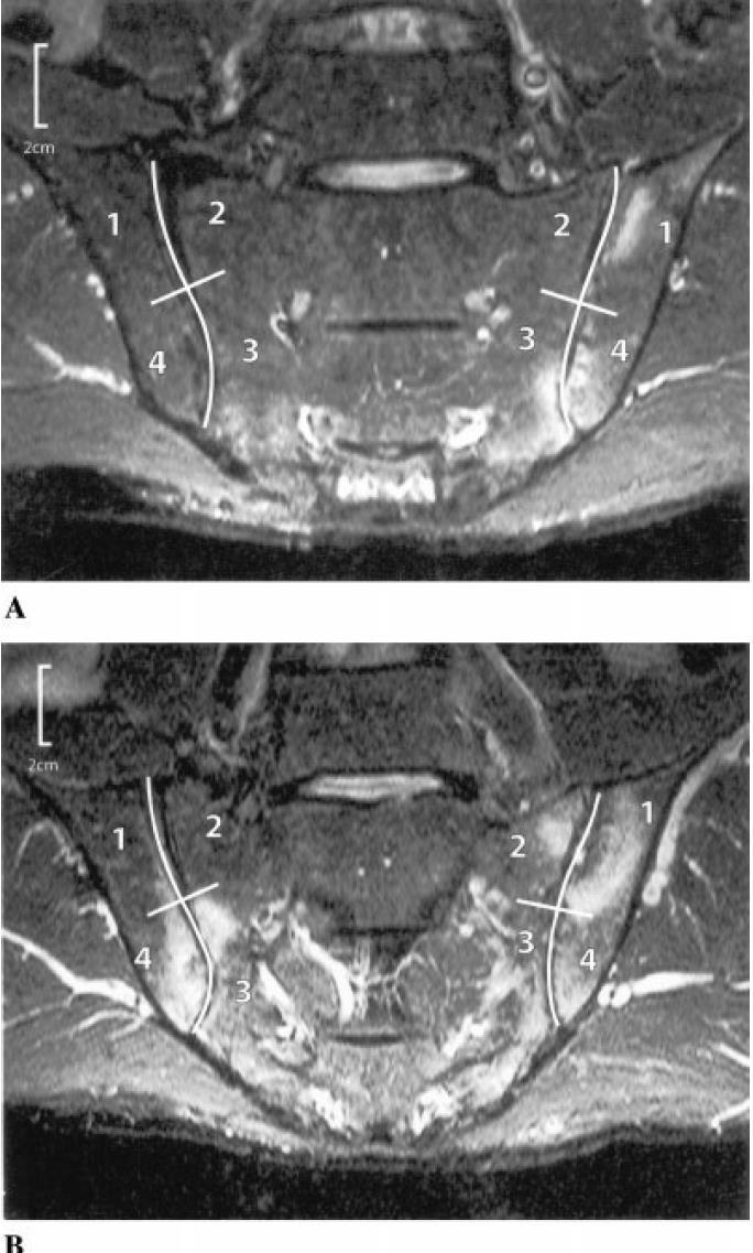 Spondyloarthritis Research Consortium of Canada (SPARCC) 0-1 (ναι όχι)