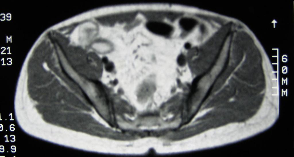 Επιβεβαίωςθ τθσ διάγνωςθσ με MRI Σ1 Διεφρυνςθ