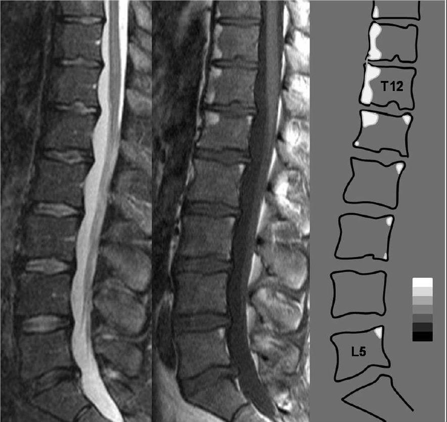 Λιπϊδθσ διικθςθ ςτθν MRI Ostergaard