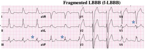 Fragmented wide QRS (QRS 120ms,