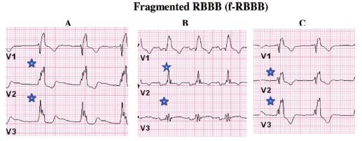 wave) In known or suspected CAD