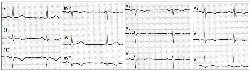 ΦΚ ρυθμός 55 bpm, QRS 90ms, QT 420ms, διατηρημένο