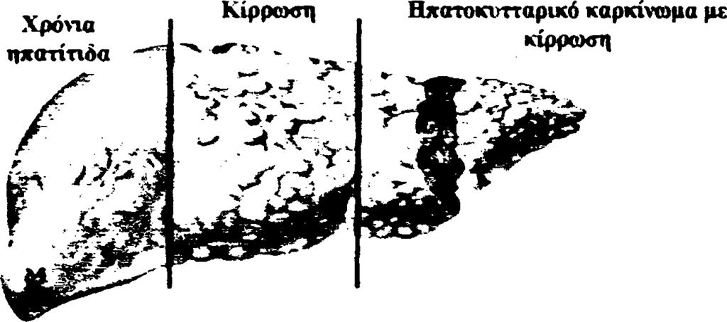 2 Σ υσχέτιση με τη χρονία ηπατίτιδα C Πρόσφατα επιδημιολογικά δεδομένα αναφέρουν ότι σε παγκόσμιο επίπεδο η λοίμωξη α πό HCV ε'ιναι ο δεύτερος σημαντικότερος παράγοντας κινδύνου για την ανάπτυξη