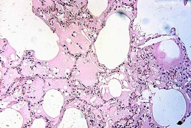 interlobular septa normal lung