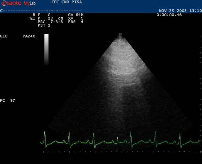 septa pulmonary oedema B-line