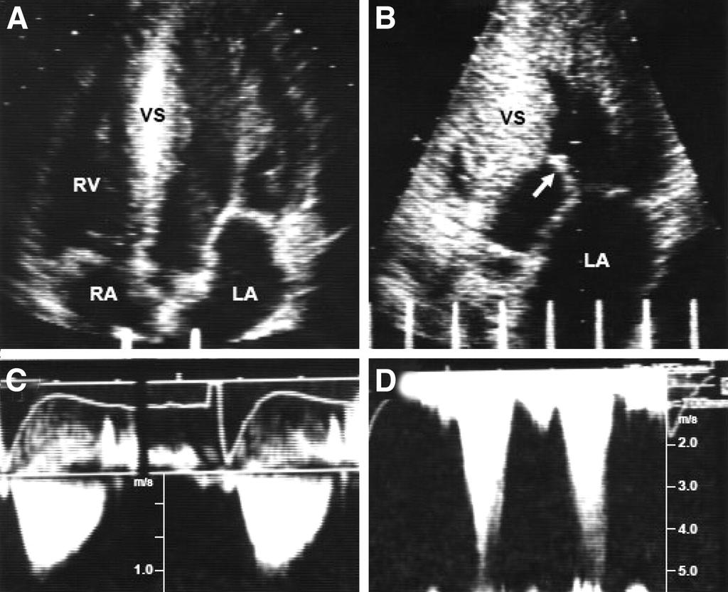 Apical 5-chamber long-axis view at rest showing mitral valve at end diastole (SAM was absent in systole) (A) with normal continuous-wave