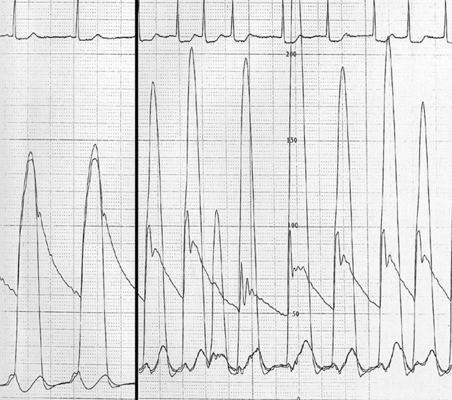Atrial