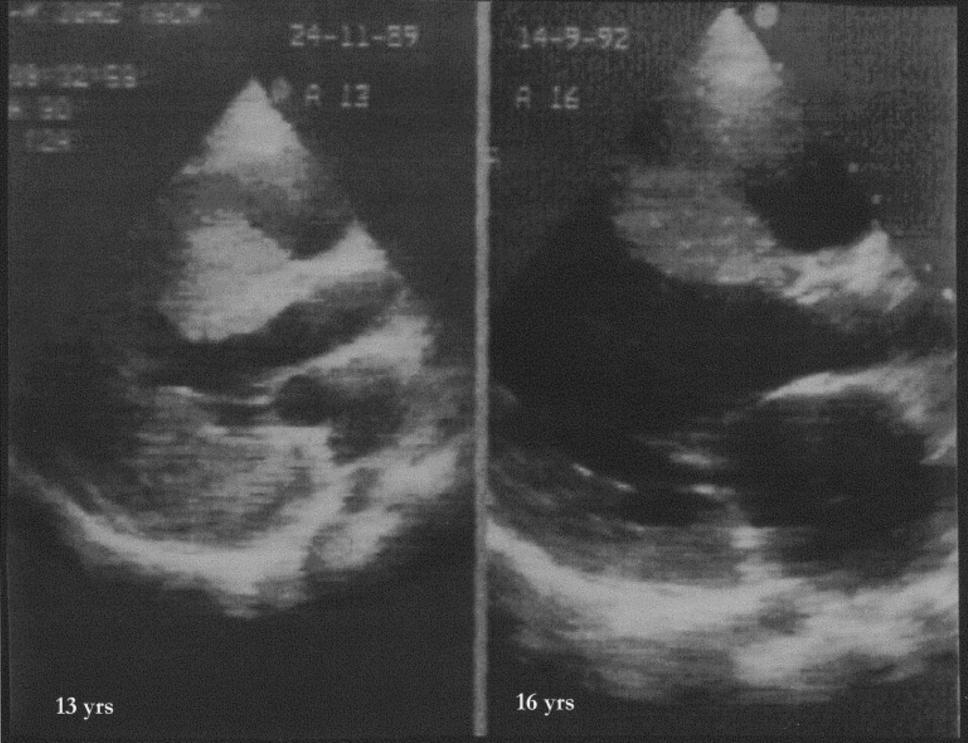 From: Dilated-Hypokinetic Evolution of Hypertrophic Cardiomyopathy: Title and subtitle BreakPrevalence, Incidence, Risk Factors, and Prognostic Implications in Pediatric and Adult Patients J Am Coll