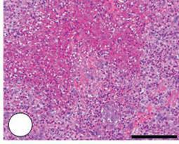 Παθο ο οα α ο ι ά The key histological features of EGPA are tissue eosinophilia,