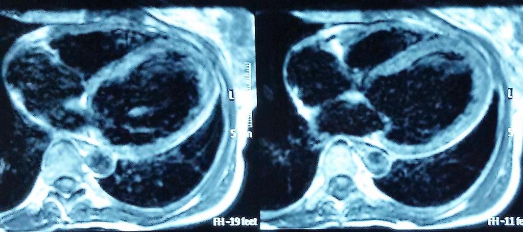 MRI καρδιάς χωρίς αλλοιώσεις μυοκαρδίου ελαφρώς λεπτότερο το μυοκάρδιο της