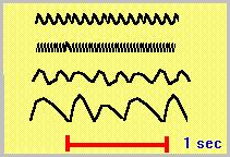 Ρυθμοί ΗΕΓ α β θ 8-12 Hz 13-30 Hz 4-7,5 Hz δ