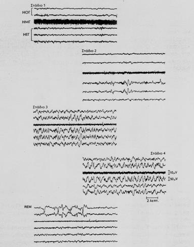 ΗΕΓ δραστηριότητες κατά τη διάρκεια του ύπνου α) Ηλεκτροοφθαλμόγραμμα ΗΟΓ β)