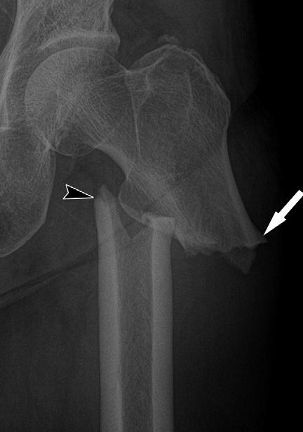 atypical subtrochanteric fracture with