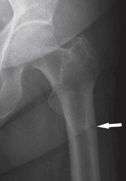 atypical subtrochanteric fracture with