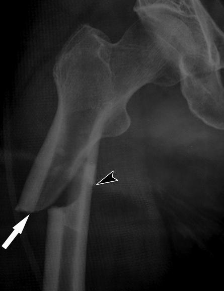 Detection of prefracture hip lesions in atypical