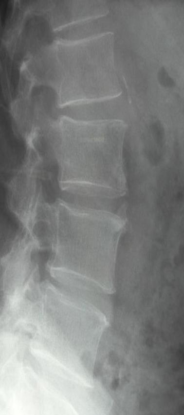 aortic
