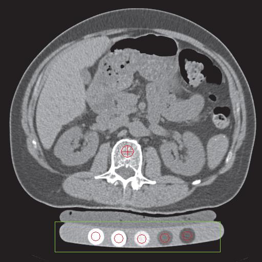 ) Asychronous QCT τεχνική: Τοµές CT συµβατικής (CT áâ κοιλίας, CT κολονοσκόπηση κλπ) - µέτρηση BMD χωρίς βαθµονοµηµένο οµοίωµα