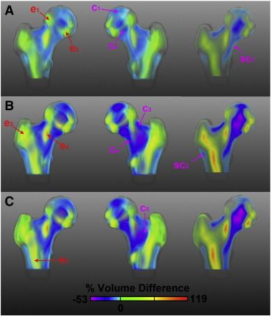 Carballido-Gamio, et al. Structuralpatterns of the proximal femur in relation to age and hip fracturerisk in women. Bone 203;57():290-99.
