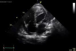 Echo and LV thrombus LV Dysfunction Acute MI and LV aneurysm ( anterior MI-first 3m min