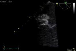 after initiation of antibiotics- after 2 w Echo