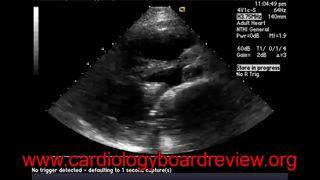 High risk sources of embolism