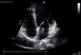 High risk sources of embolism Cardiac tumours MYXOMA (