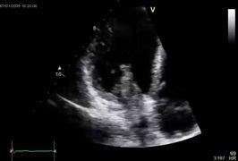 30-40% embolic phenomena MRI or CT, if stalk NOT seen)