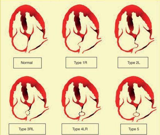 Paradoxical embolism PFO = rare cause of neurological ischaemic events a. venous thrombosis b.