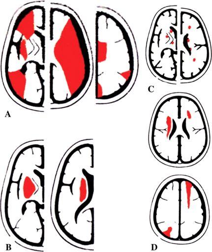 Schematic drawings of patterns of brain infarctions signalling different stroke mechanisms. Pepi M et al.