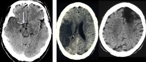 Left panel: hyperdense middle cerebral artery-sign (dense artery sign; arrow): embolic occlusion of middle cerebral artery in a 70-year-old patient with intermittent atrial fibrillation. Pepi M et al.