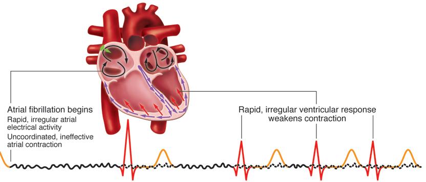 AF: Complex pathophysiology Camm AJ, et al.