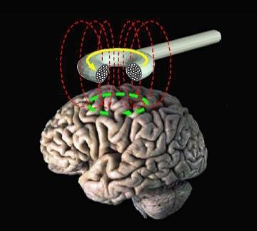 Transcranial Magnetic Stimulation Μαγνητικός ερεθισμός