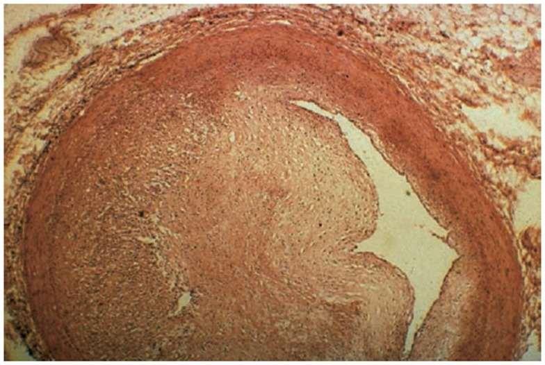 ΑΚΤΙΝΙΚΗ ΣΤΕΦΑΝΙΑΙΑ ΝΟΣΟΣ Significant fibrosis of the