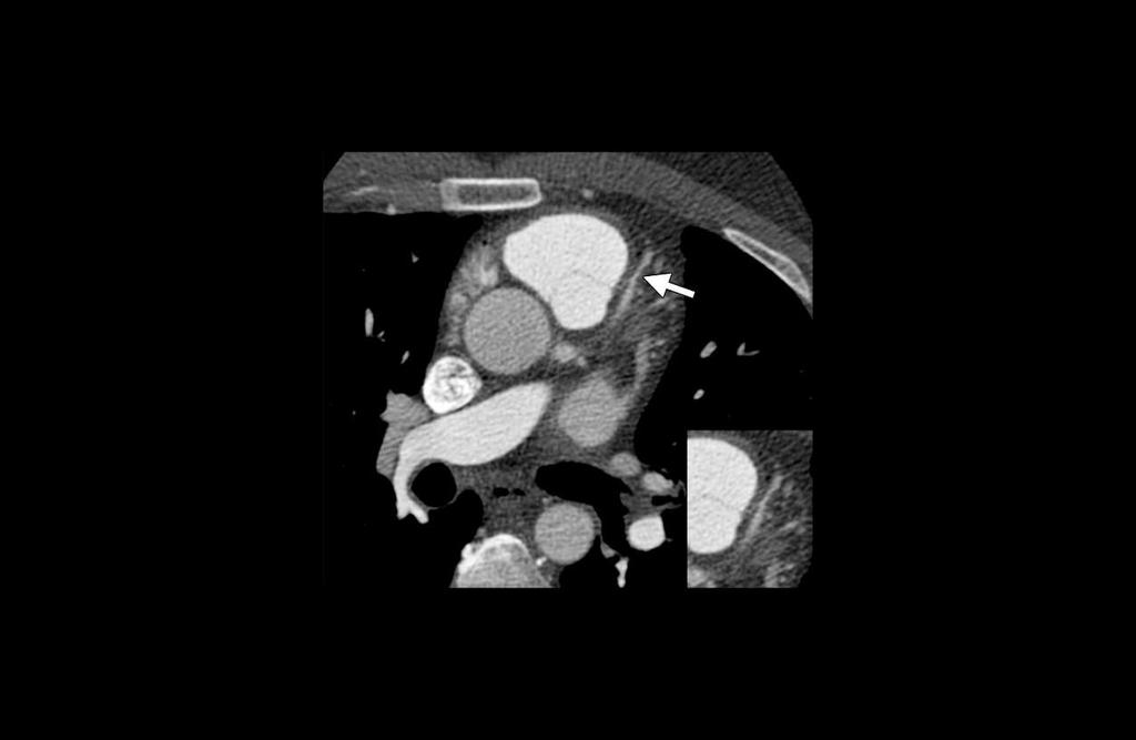 Figure. Coronary artery disease in a 37-year-old man with no cardiovascular risk factors but with a history of receiving 39.6 Gy of mantle irradiation.