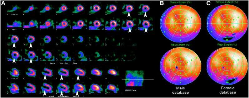 PROVOCATIVE TESTING Nuclear perfusion scans - the most widely investigated modality for the detection of CAD - can be performed with exercise, or in