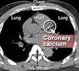 IMAGING MODALITIES Computed tomography coronary angiogram (CTCA)/Coronary calcium score - information on the vascular lumen and the arterial wall - significant stenosis can occur in the absence of