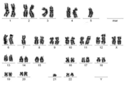 Monosomal Karyotype (MK) Η ύπαρξη 1 μονοσωμίας (ΑΜ) στον καρυότυπο σε συνδυασμό με