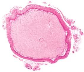 centralis retinae snopovi æivëanih vlakana vena
