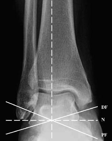 11 13 cm 2. Η ζέζε ηεο άξζξσζεο θαη ε θαηάζηαζε ησλ ζπλδέζκσλ θαζνξίδεη ηελ θαηαλνκή ησλ θνξηίσλ ζηνλ αζηξάγαιν.