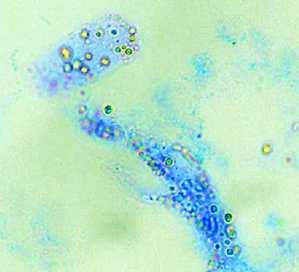 tukových valcov, lipidové častice Vznik tukových valcov: lipoproteínové častice prenikajú do moču tubulárne bunky/epitélie/ zachytia tukové