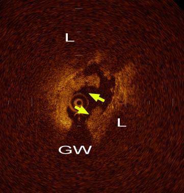 Κλινική Χρήση IVUS και OCT