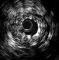 Effect of underexpansion (inadequate stent dimensions) 100 p= 0,03 8 p= 0,02 80 60 40 20 0 Stent