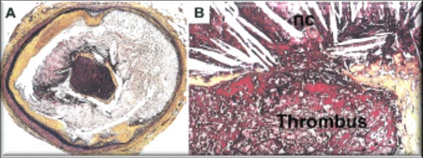 8 mm 2 & ~9 mm long Fibrous cap Reduced Thickness, ~23 μm (95% <65 μm) Increased Macrophage Density, ~26% of