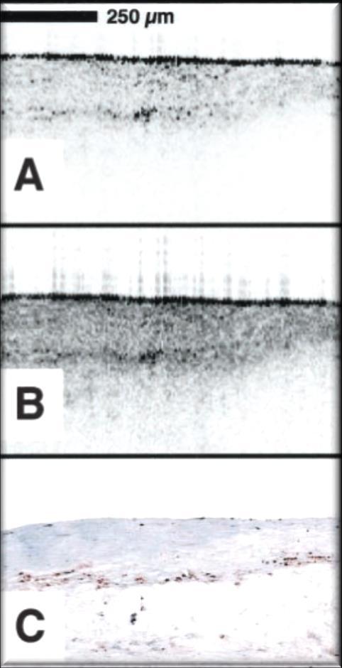 Macrophage Content Sensitivity: