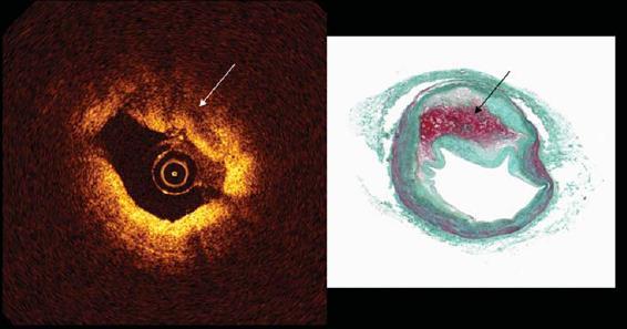 Intraplaque Hemorrhage