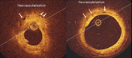 Neovascularization (?