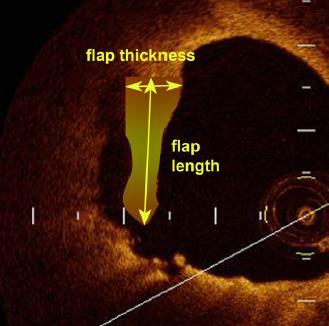 Clinical impact of edge dissections in ACS Deep vessel wall