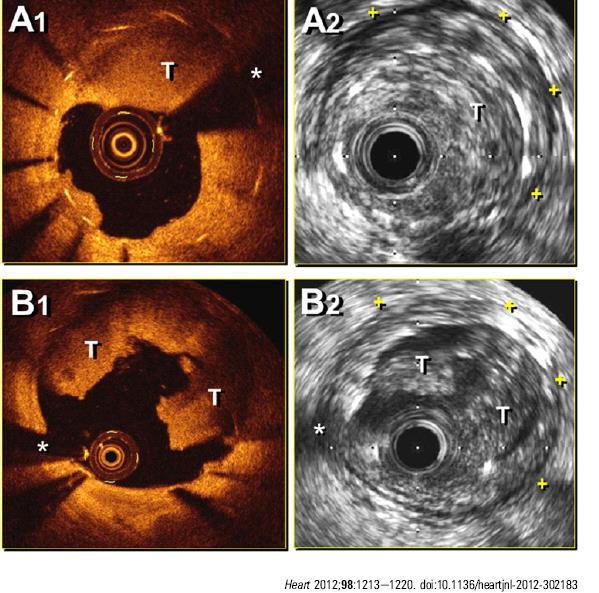 Stent thrombosis