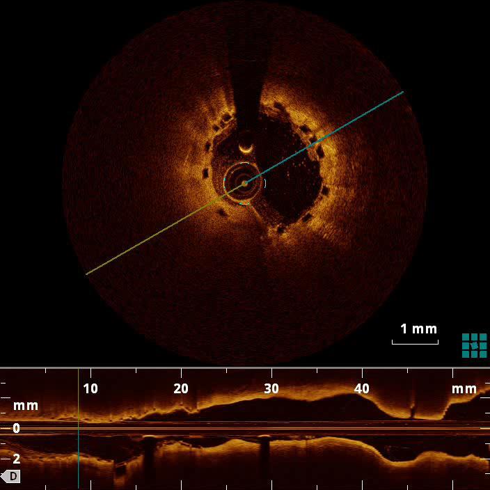 BVS STEMI Diletti R, Karanasos A, Muramatsu