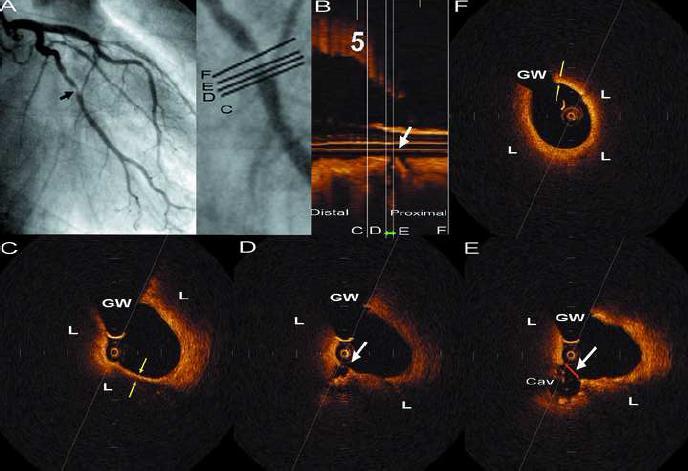 Difference in rupture between STEMI & NSTEMI STEMI